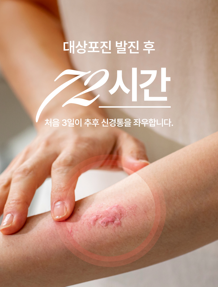 대상포진 초기